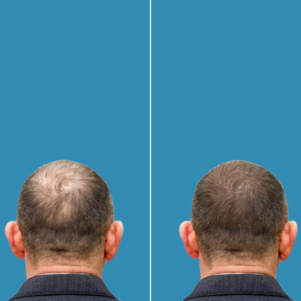 Before and after male crown hair transplant at Aphrodite Clinic Turkey