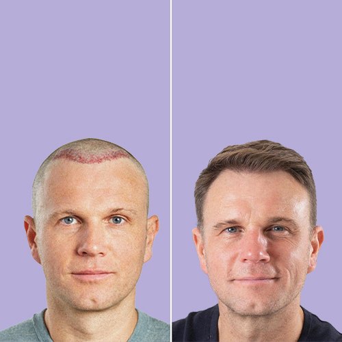 Before and after male hair transplant at Aphrodite Clinic Turkey
