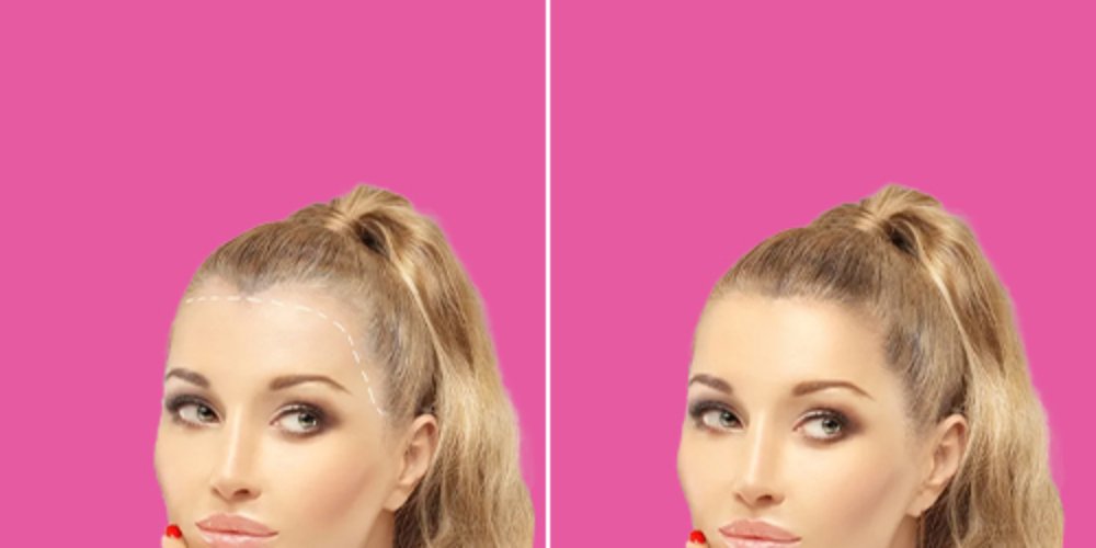 Before and after female facelift or brow lift at Aphrodite Clinic Turkey