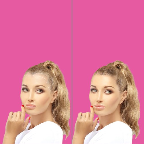Before and after female facelift or brow lift at Aphrodite Clinic Turkey