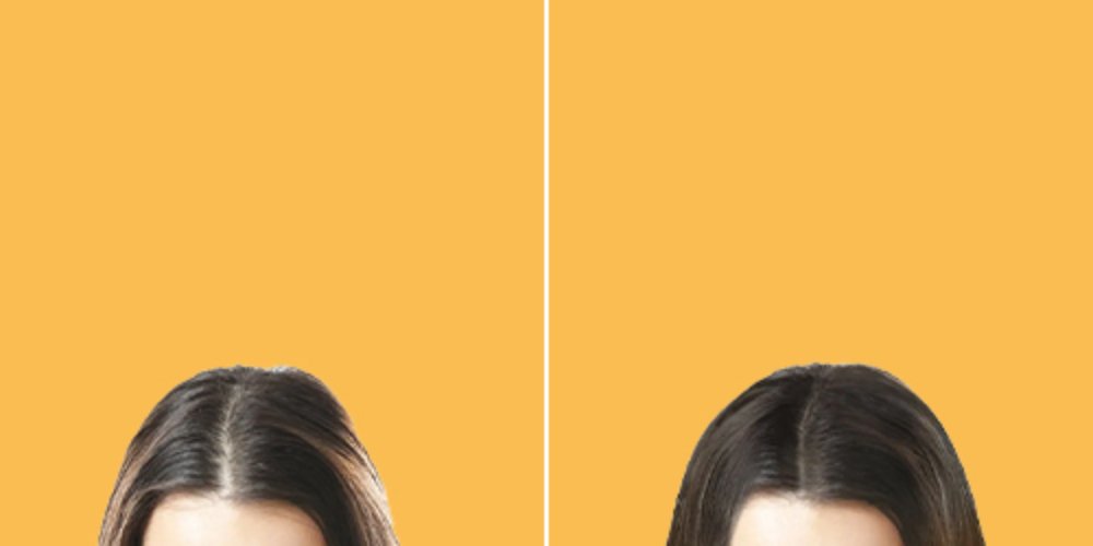 Before and after female hair transplant for receding hairline at Aphrodite Clinic Turkey
