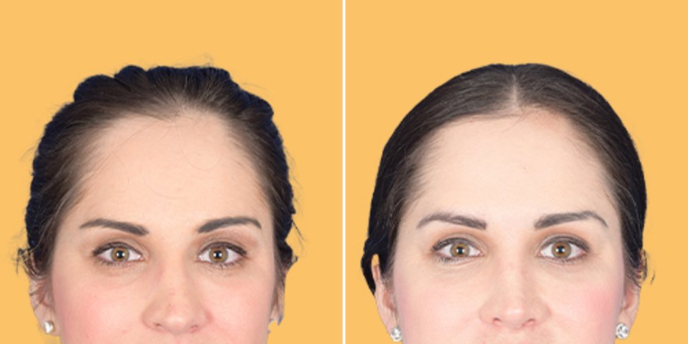Before and after female rhinoplasty frontal view at Aphrodite Clinic Turkey