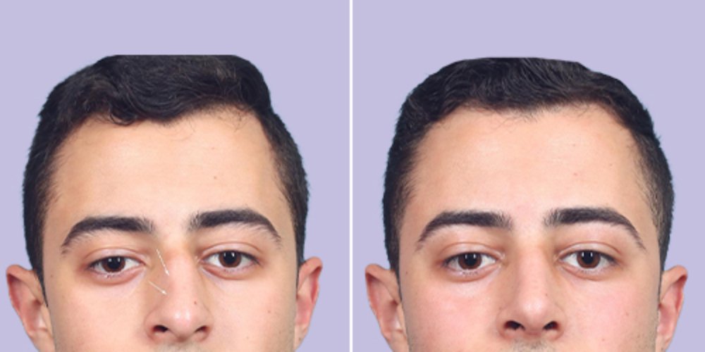 Before and after male rhinoplasty frontal view at Aphrodite Clinic Turkey