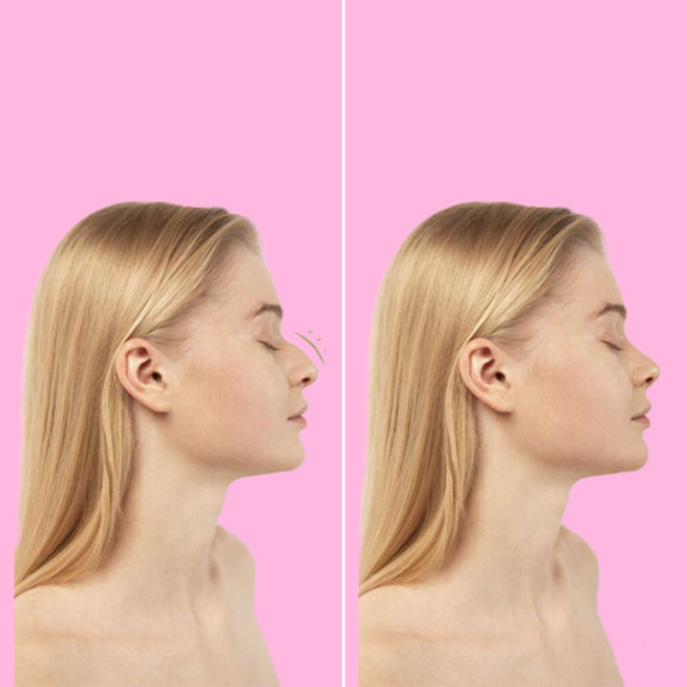 Before and after female nose reshaping side view at Aphrodite Clinic Turkey