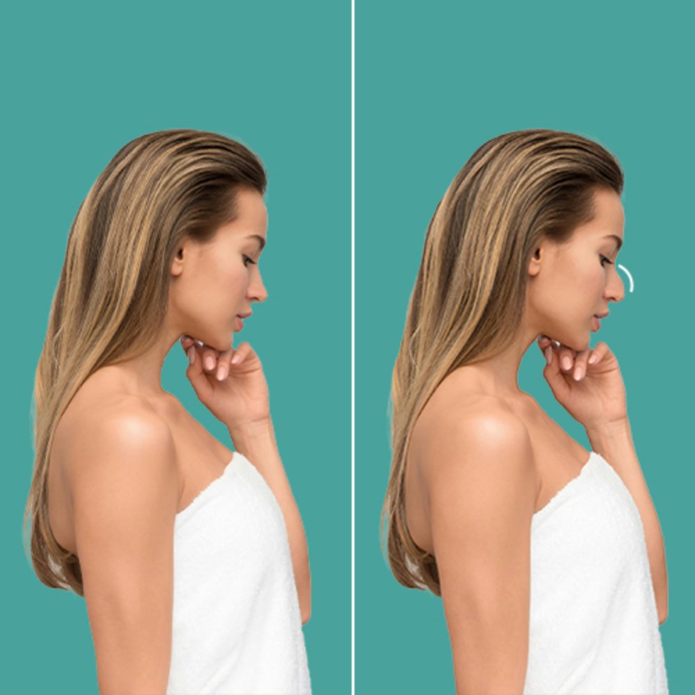 Before and after female rhinoplasty side view at Aphrodite Clinic Turkey