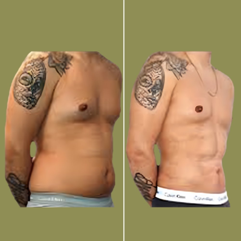 Before and after male side liposuction and waist sculpting at Aphrodite Clinic Turkey