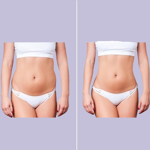 Before and after tummy tuck procedure at Aphrodite Clinic Turkey