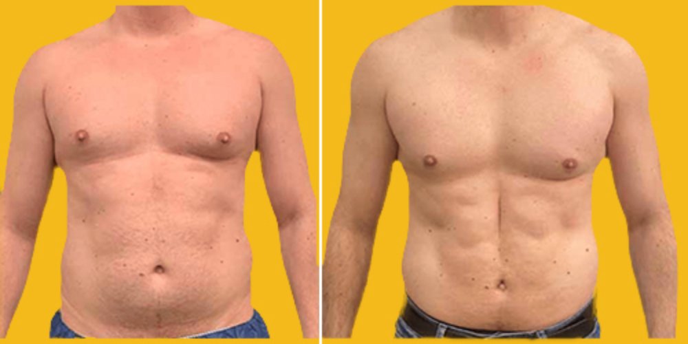 Before and after male liposuction and body contouring at Aphrodite Clinic Turkey